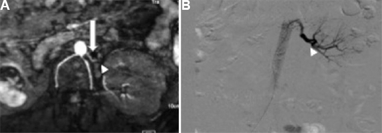 Unenhanced magnetic resonance angiography (A) of 23 yr old female patient, a known case of fibromuscular dysplasia with history of right nephrectomy and left renal artery stenting revealed 50-60 per cent at the ostia (arrow) and >80 per cent in the distal left main renal artery (arrowhead). (B) Digital subtraction angiography confirmed stenosis at the ostia but revealed normal distal main renal artery to be normal (arrowhead).